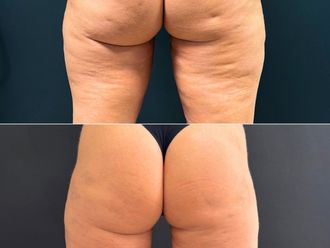Cellulite prima e dopo - 876394
