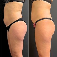 Equilybra Medical Beauty Center Percorso corpo adiposità localizzate