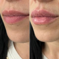 Equilybra Medical Beauty Center Lip Filler
