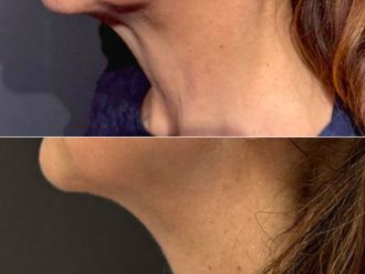 Laserterapia prima e dopo - 876726