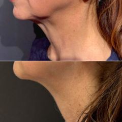 Equilybra Medical Beauty Center miglioramento della definizione del profilo mandibolare