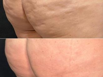 Cellulite prima e dopo - 878673