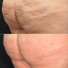 Equilybra Medical Beauty Center Trattamento Cellulite fibrosa