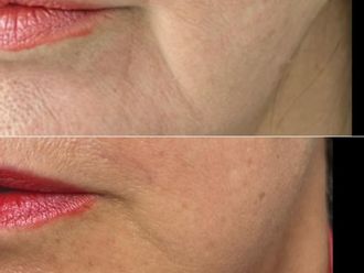 Filler prima e dopo - 879858