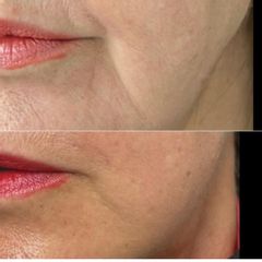 Equilybra Medical Beauty Center Rughe della marionetta