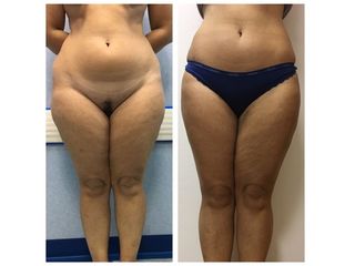 Liposuzione prima e dopo