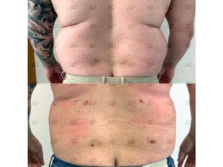 Liposuzione prima e dopo