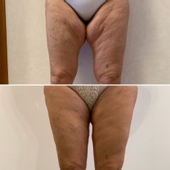 Lifting cosce prima e dopo