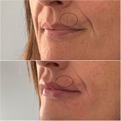 Filler Labbra prima e dopo