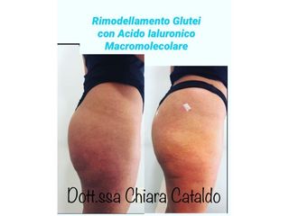 Acido ialuronico glutei prima e dopo