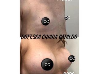 Mastoplastica additiva prima e dopo