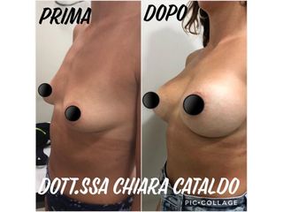 Mastoplastica additiva prima e dopo