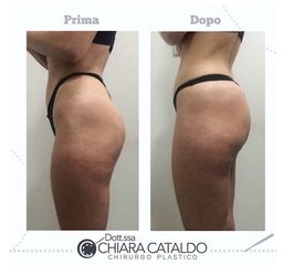Gluteoplastica prima e dopo