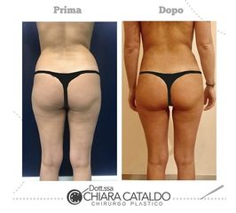 Gluteoplastica prima e dopo