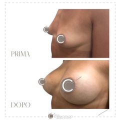 Mastoplastica additiva - Dott.ssa Chiara Cataldo