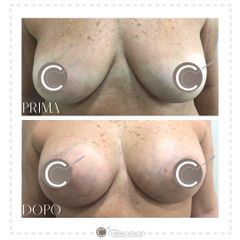 Mastoplastica additiva - Dott.ssa Chiara Cataldo