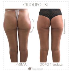 Criolipolisi - Dott.ssa Chiara Cataldo