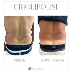 Criolipolisi - Dott.ssa Chiara Cataldo