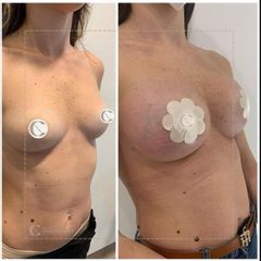 Mastoplastica additiva - Dott.ssa Chiara Cataldo