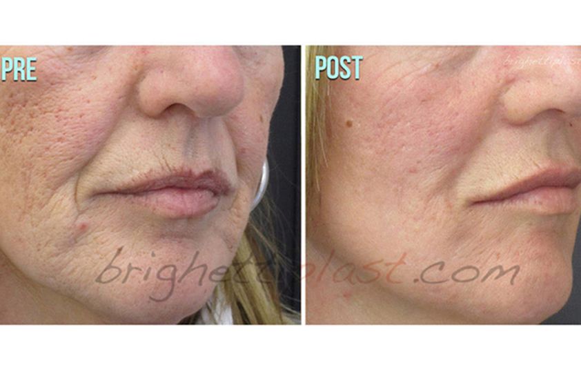 Laserterapia prima e dopo - 751251