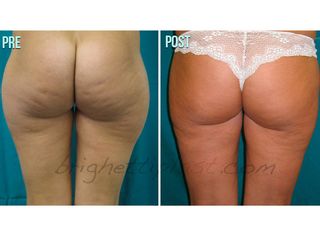 Liposuzione prima e dopo