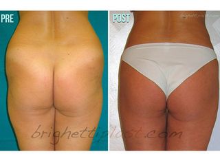 Liposuzione prima e dopo