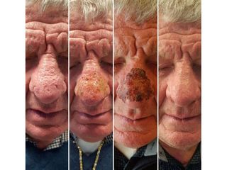 Laserchirurgia del rinofima - Skin Center