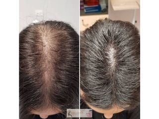 Trapianto capelli - Skin Center