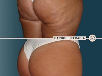 Carbossiterapia prima e dopo - 872937