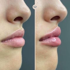 Mens Sana Clinique Filler labbra