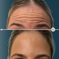 Mens Sana Clinique Botox