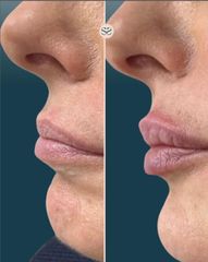 Mens Sana Clinique Filler labbra