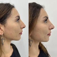 Mens Sana Clinique Rinofiller
