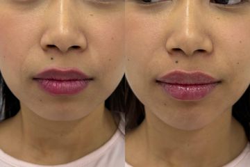 Mens Sana Clinique Filler labbra + mento