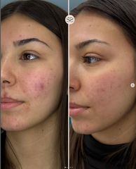 Mens Sana Clinique Acne