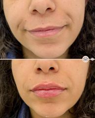 Mens Sana Clinique Filler labbra
