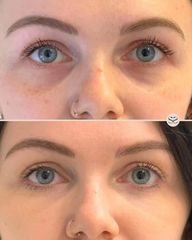 Mens Sana Clinique Filler occhiaie