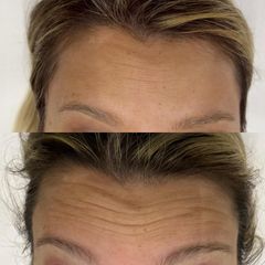Botox