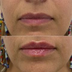 Mens Sana Clinique Filler labbra