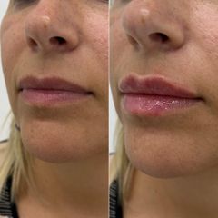 Mens Sana Clinique Filler labbra