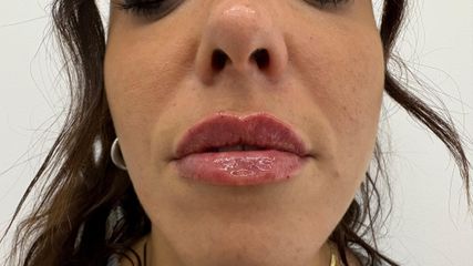 Mens Sana Clinique Filler labbra