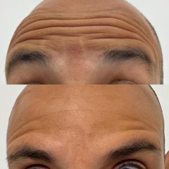 Mens Sana Clinique Botox