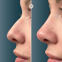 Mens Sana Clinique Rinofiller