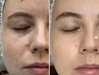 Asportazione nei prima e dopo - 876784