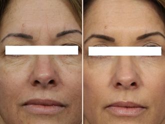 Laser CO2 frazionato prima e dopo - 876785