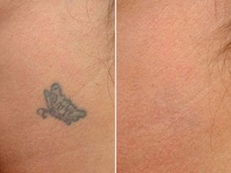 Rimozione tatuaggi prima e dopo - 876786