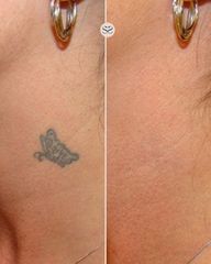 Mens Sana Clinique Rimozione tatuaggio