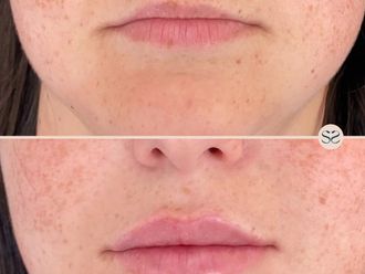 Filler labbra prima e dopo - 876787