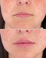 Mens Sana Clinique Filler labbra