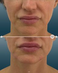 Mens Sana Clinique Filler mento